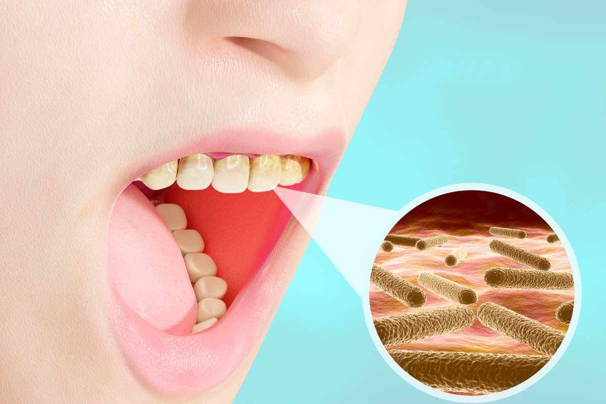 i germi possono rovinare i denti come le carie