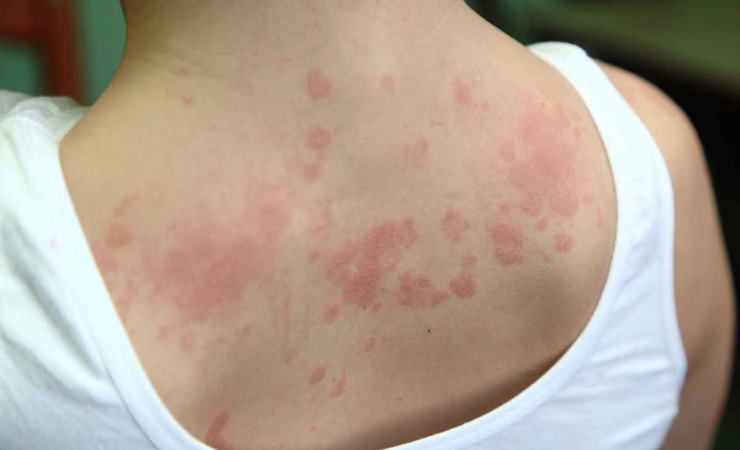 Sintomi reazione allergica medicinali