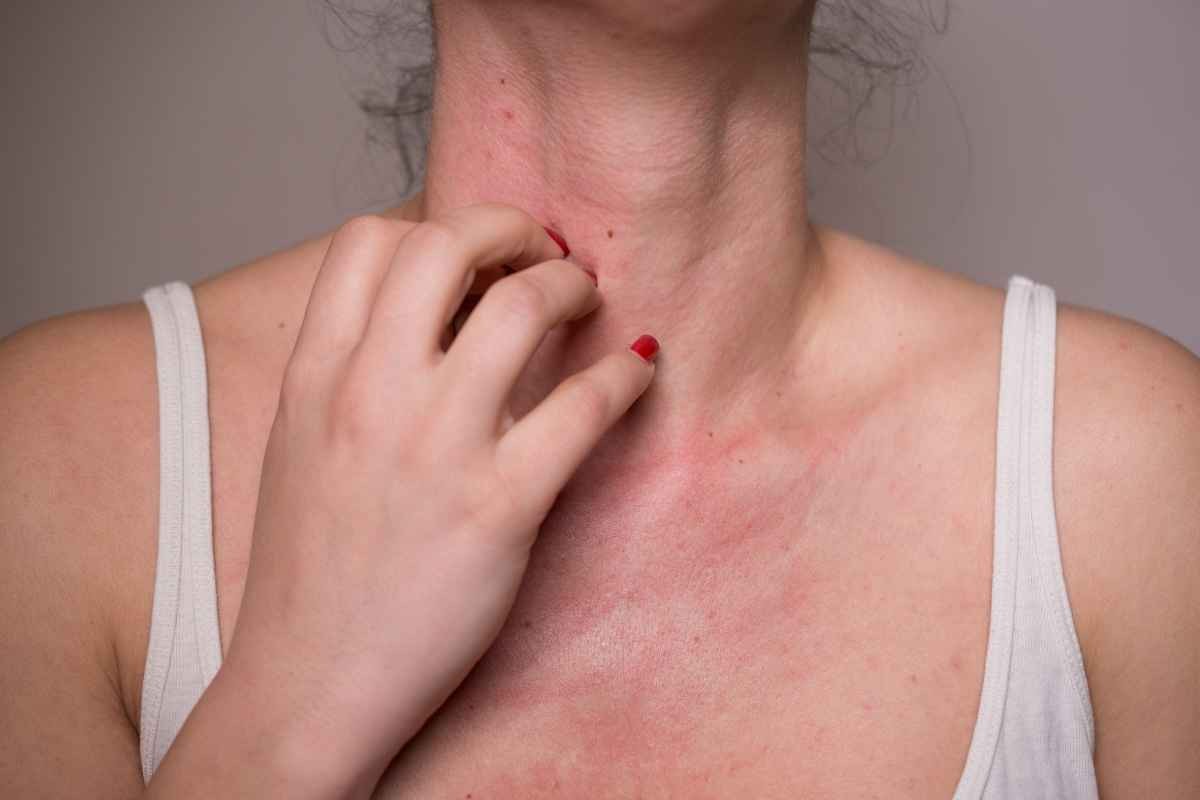 allergia nichel precauzioni